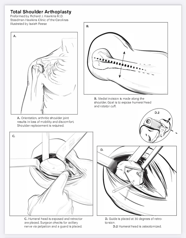 Surgical breakdown one - Part one of a surgical breakdown. Total shoulder arthroplasty, done in Adobe Illustrator.