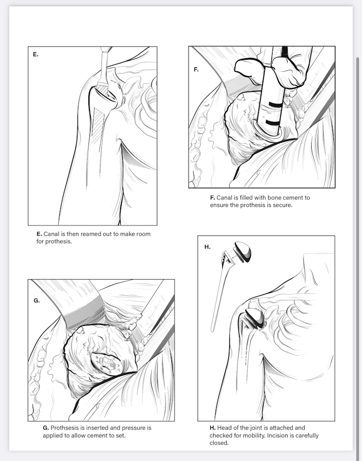 Surgical breakdown two - Part two of a surgical breakdown. Total shoulder arthroplasty, done in Adobe Illustrator.