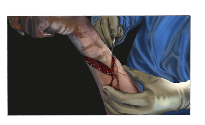 Surgical illustration two - Surgical scene, amputation of a gangrene infected arm. Illustrated in Procreate.