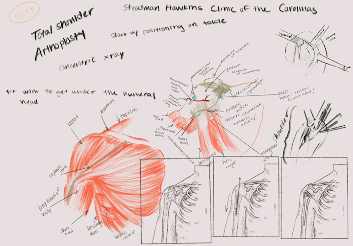 Surgical sketches two - Surgical sketches, total shoulder arthroplasty.