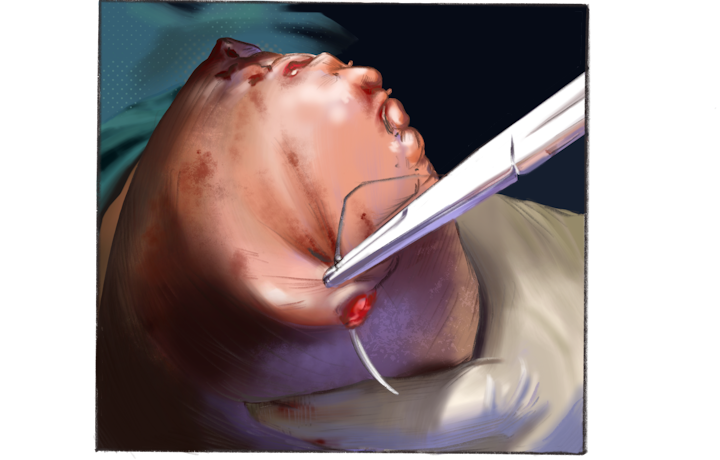 Surgical illustration three - Surgical scene, amputation of a gangrene infected arm. Illustrated in Procreate.