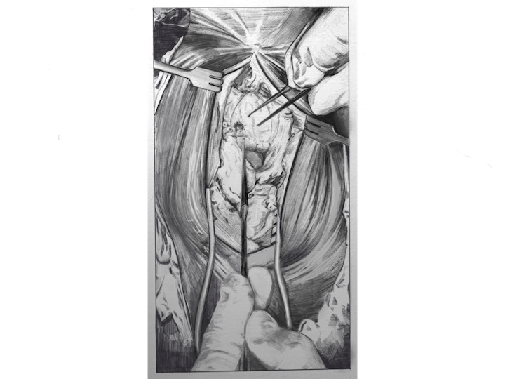 Surgical illustration one - Surgical scene, removal of a lesion from the patella. Done in graphite.