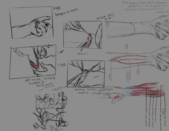 Surgical sketches one - Surgical sketches, amputation of a gangrene infected arm.